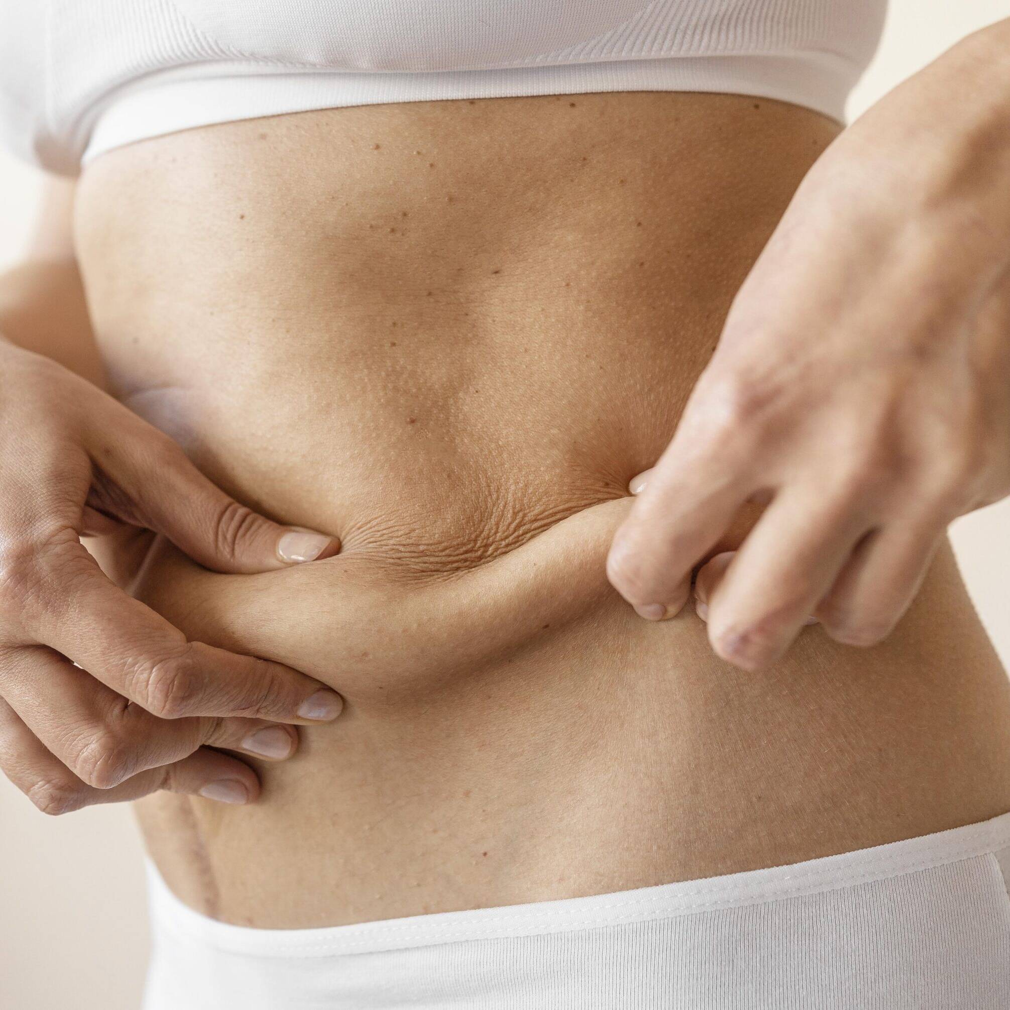 A flacidez pode aparecer em várias partes do corpo, incluindo o rosto, braços, glúteos, coxas e barriga. Os Biostimuladores de Colágeno ajudam a melhorar a elastina, aumentando a firmeza da pele e diminuindo a flacidez destar regiões.