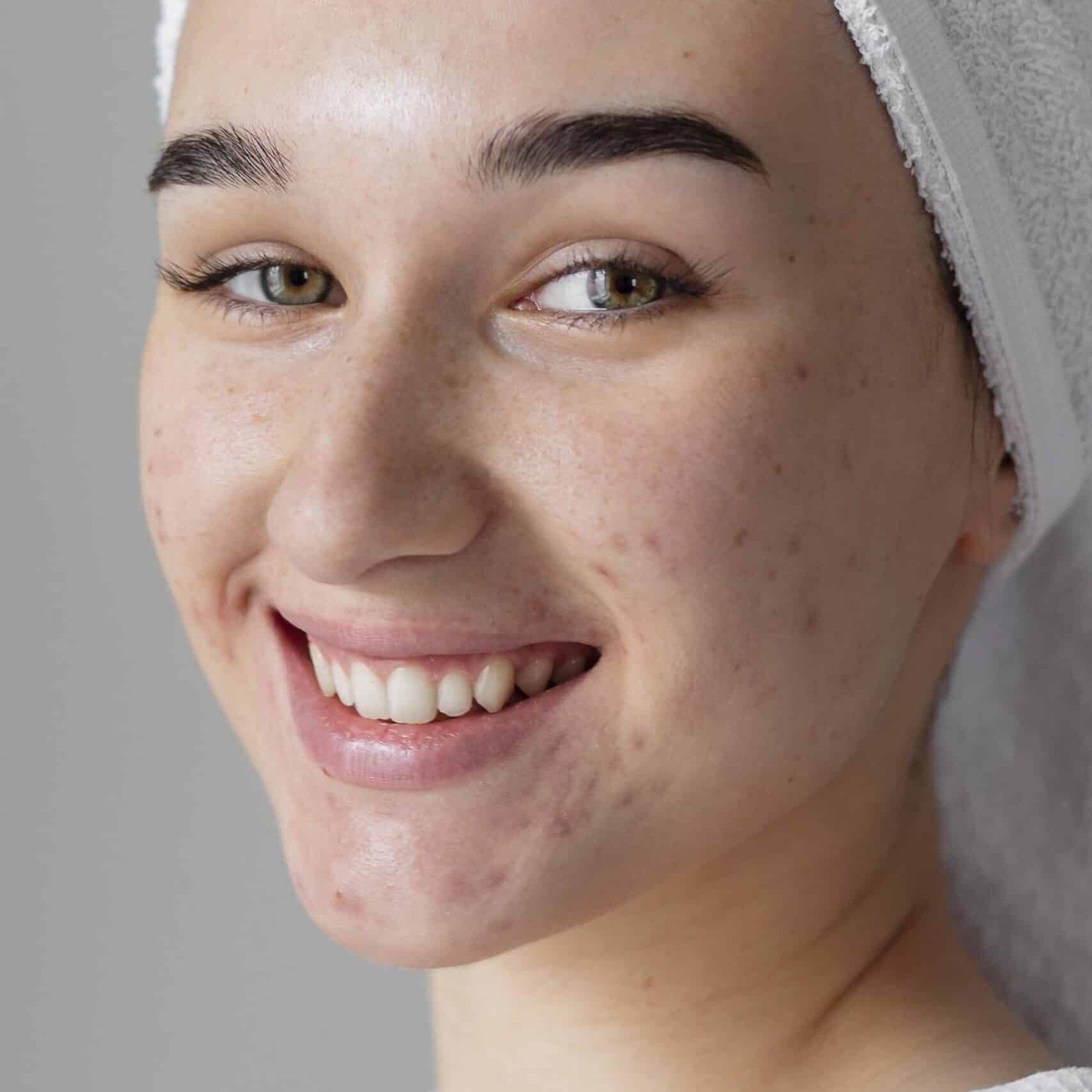 As cicatrizes de acne podem ser indesejáveis e difíceis de tratar. Os Bioestimuladores de Colágeno ajudam a promover uma regeneração natural da pele, reduzindo a aparência de cicatrizes.